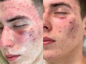 Как убрать большой прыщ?