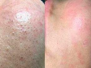 Как убрать черные точки на лице у мужчины