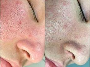 Как убрать черные точки на лице у подростка