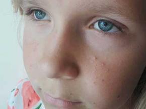 Как убрать черные точки на лице у ребенка