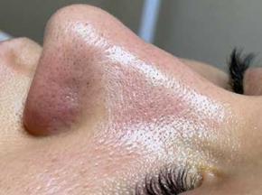 Как убрать черные точки на носу в домашних условиях