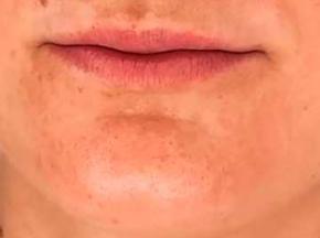 Как убрать черные точки на подбородке