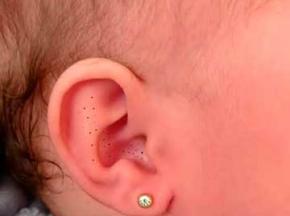 Как убрать черные точки в ушах у ребенка 