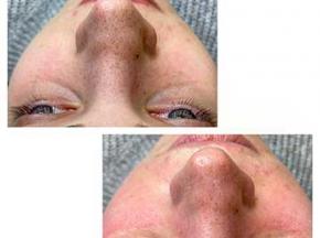 Как убрать чёрные точки?