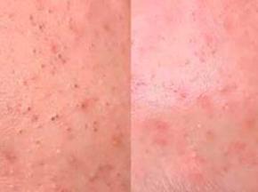 Как убрать чёрные точки на лице в домашних условиях