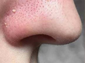 Как убрать комедоны на носу