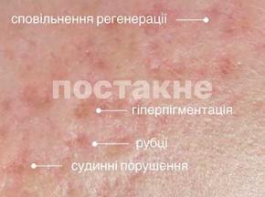 Как убрать рубцы от прыщей