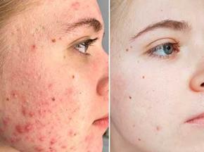 Как убрать шрамы от прыщей