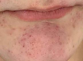 Как убрать сыпь на подбородке