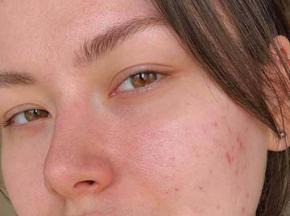 Как удалить комедоны