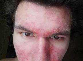 Красная сыпь на лице