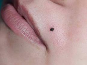 Красная сыпь на носогубном треугольнике