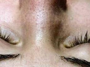 Лечение черных точек