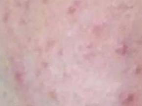 Мелкая сыпь на лбу у женщин