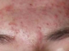 На лбу прыщи как сыпь
