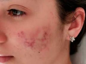 Надавила прыщи. Как убрать красноту?