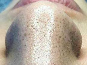 Народные средства от черных точек