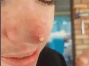 Прыщ на носу. Как убрать? 