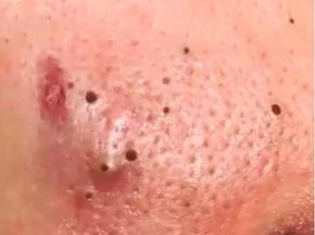 Средство от черных точек на лице