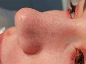 Средства от черных точек в домашних условиях