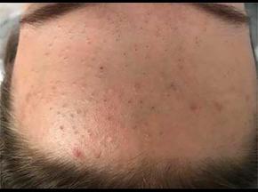 Средство от черных точек