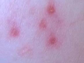 Сыпь на лбу у ребенка