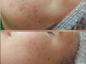 Сыпь на лице у подростка