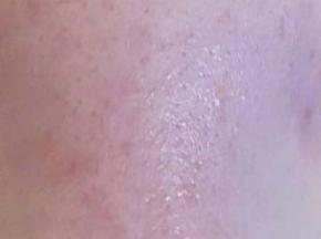 Сыпь на носу