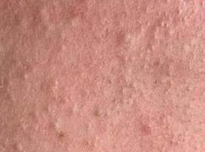 Сыпь на руках в виде маленьких прыщей