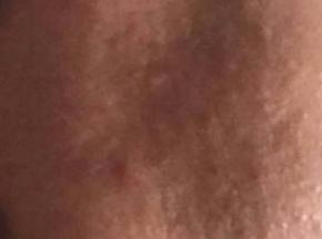 Сыпь на руке чешется