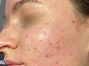 Сыпь на щеках у взрослого