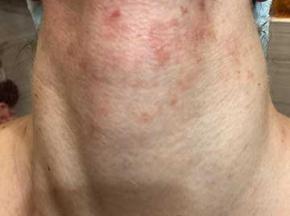Сыпь на шее и грудной клетке