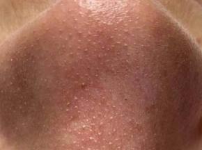 Сыпь на шее у ребенка