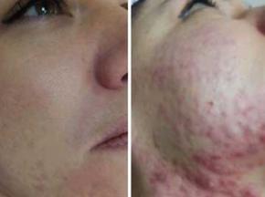 Сыпь на шее у взрослого