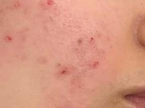 Сыпь на скулах