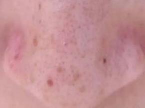 Сыпь под носом