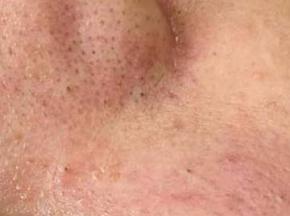 Сыпь возле крыльев носа