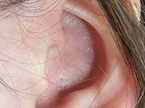 Удаление комедонов в ушах