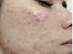 Высыпания на лице психосоматика 