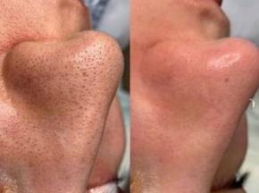 Как убрать черные точки на носу у подростка в домашних условиях