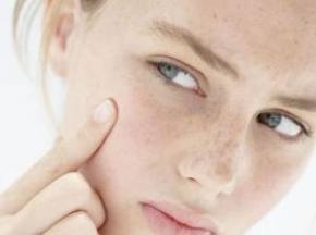 Как убрать прыщи на лице у подростка в домашних условиях