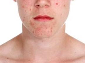 Как избавиться от прыщей на подбородке