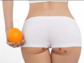 Как избавиться от прыщей на попе