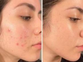 Как избавиться от пятен после прыщей